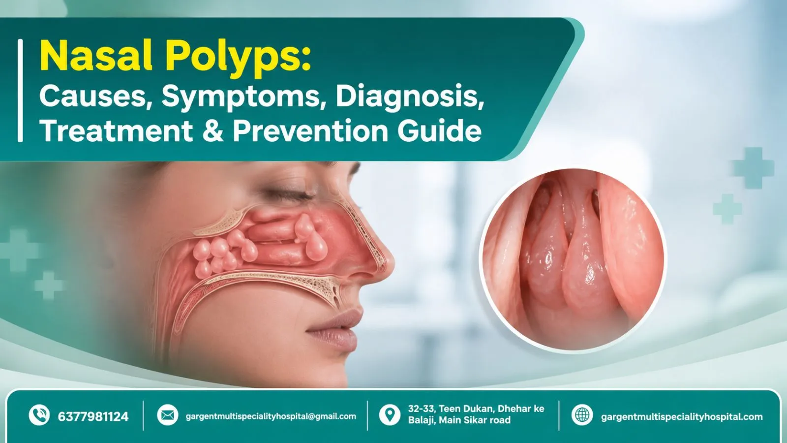 Nasal Polyps: Causes, Symptoms, Diagnosis, Treatment & Prevention Guide